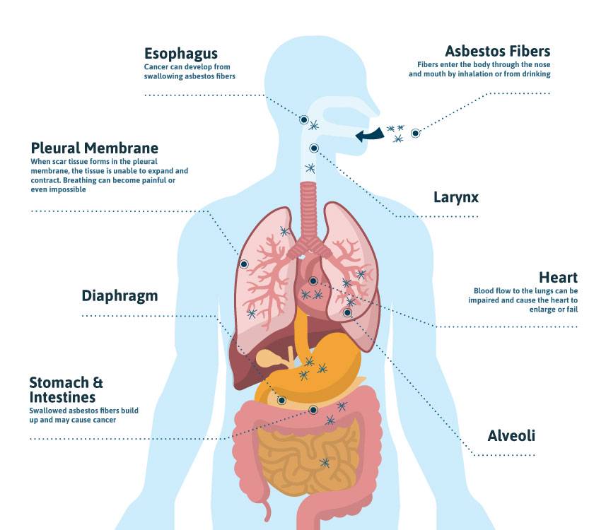 asbestos lawyer Beaumont, asbestos help Beaumont, asbestos care SETX, asbestos health Southeast Texas, asbestos settlement Port Arthur TX, asbestos Orange TX, Asbestos Health Line,